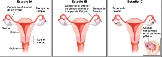 Salpingo-Oophorectomy : 输卵管卵巢切除术