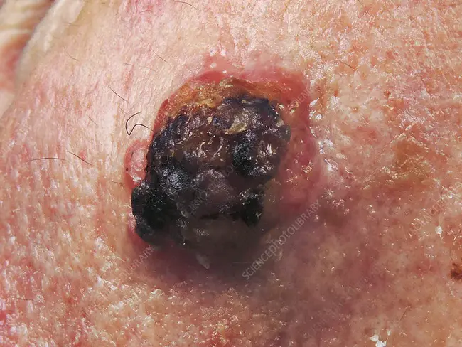Sarcomatoid Thymic Carcinoma : 肉瘤样胸腺癌