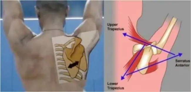 scapuloperoneal myopathy : 肩胛骨肌病