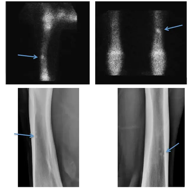 scintigraphy : 闪烁照相术