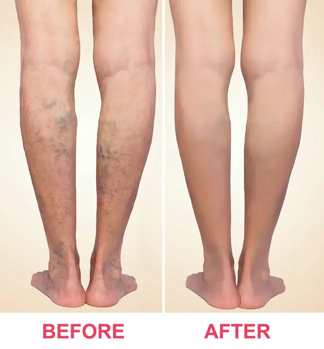 ScleroTherapy : 硬化疗法