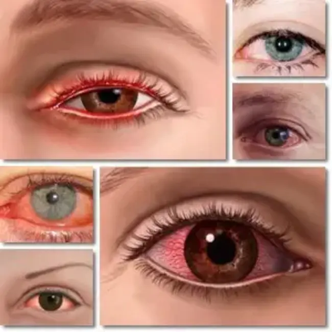 Seasonal Acute Conjunctivitis : 季节性急性结膜炎