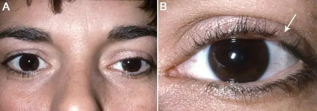 Sebaceous Carcinoma : 皮脂腺癌