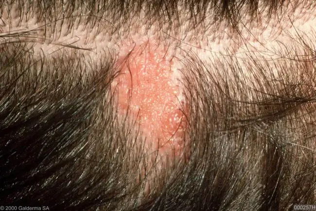 Sebaceous Nevus : 皮脂腺痣