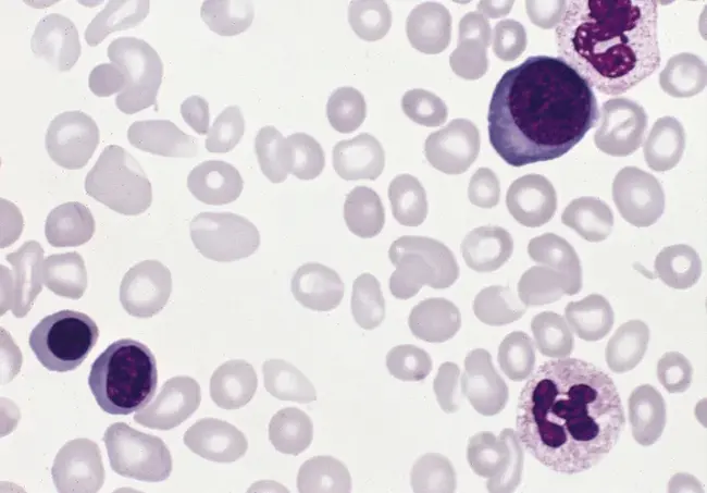 Secondary Polycythaemia : 继发性多囊血
