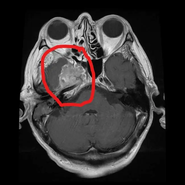 Secretory Carcinoma : 分泌癌