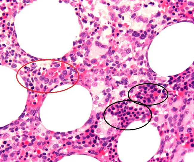 Secretory Cell Metaplasia : 分泌细胞化生