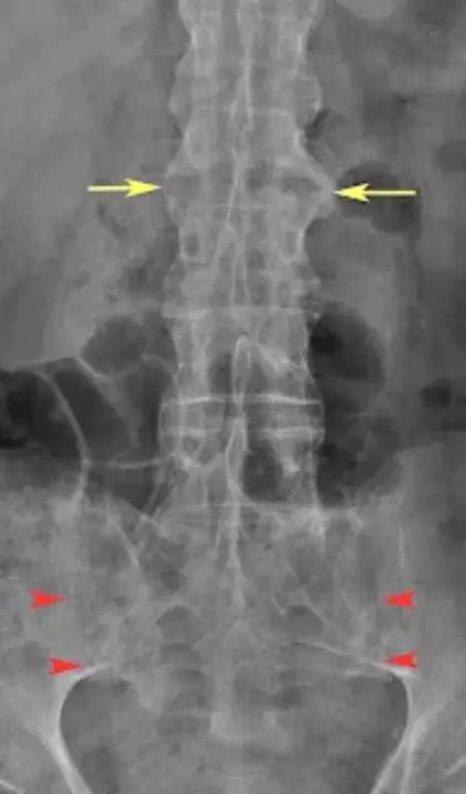 Seronegative SpondyloArthropathy : 血清阴性脊椎关节病