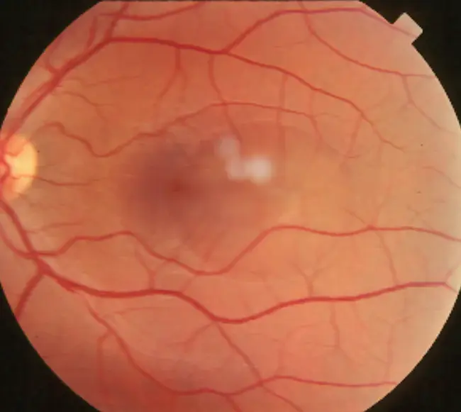 Serous Retinal Detachment : 浆液性视网膜脱离