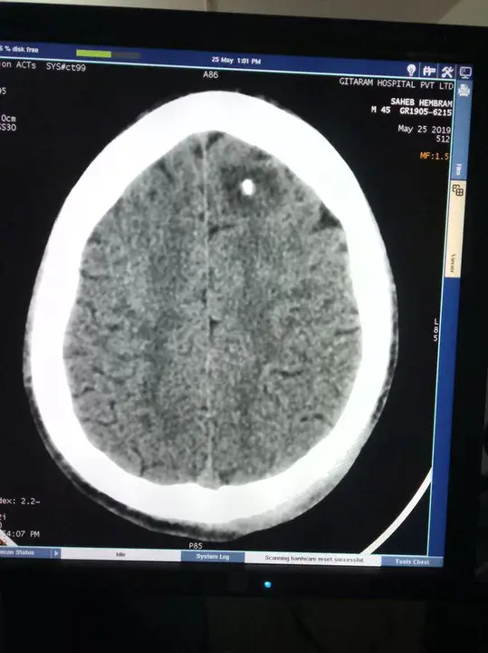 Single Primary Tumour : 单一原发性肿瘤