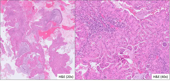 sinonasal polyposis : 鼻腔息肉病