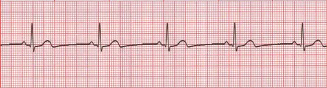 Sinus Tachycardia : 窦性心动过速