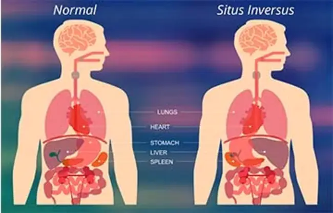 Situs Inversus : 倒位