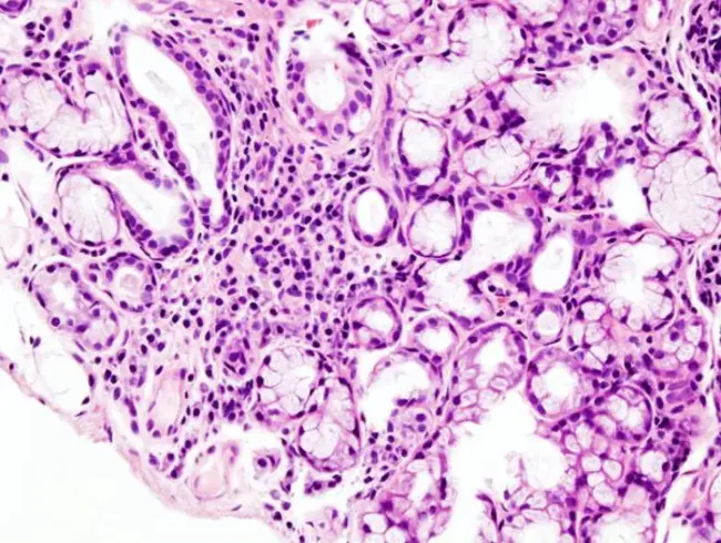 Sjögren syndrome : 干燥综合征