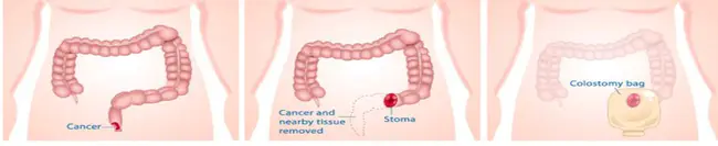 Sphincter-Saving Resection : 保括约肌切除术