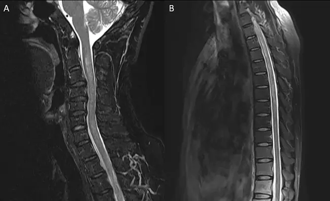 Spinal Trigeminal Nucleus : 脊柱三叉神经核