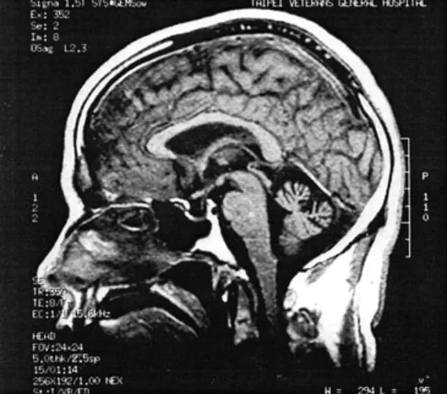 spinocerebellar ataxia with epilepsy : 脊髓小脑共济失调伴癫痫