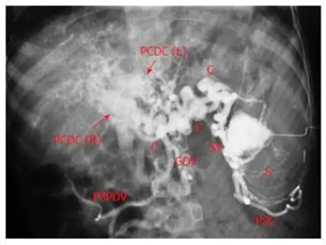 splenoportovenography : 脾动脉造影