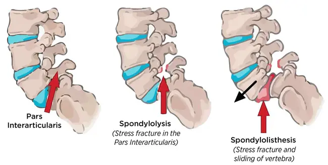 spondylolysis : 椎弓峡部裂