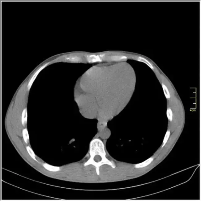 spontaeous pneumomediastinum : 海绵状纵隔气肿