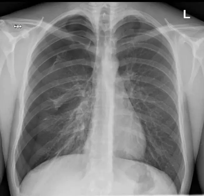 Spontaneous Pneumothorax : 自发性气胸