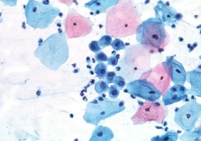 Squamous Cell Metaplasia : 鳞状细胞化生