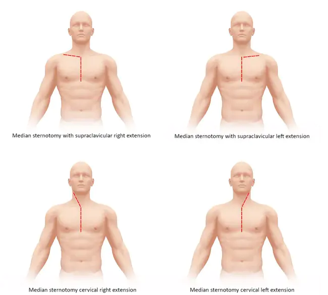 Standard Sternotomy : 标准胸骨切开术