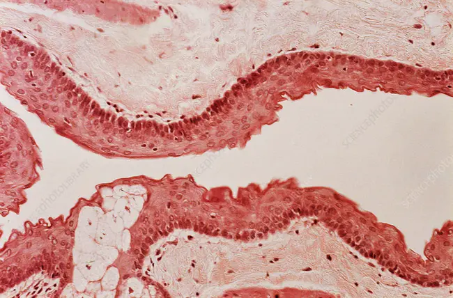 steatocystoma multiplex : 多发性脂肪囊瘤