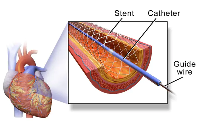 Stent Thrombosis : 支架血栓形成