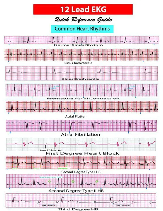 Stretch-Induced Arrhythmia : 伸展性心律失常