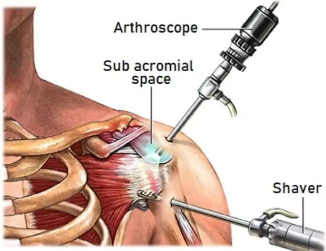 Subacromial decompression : 肩峰下减压