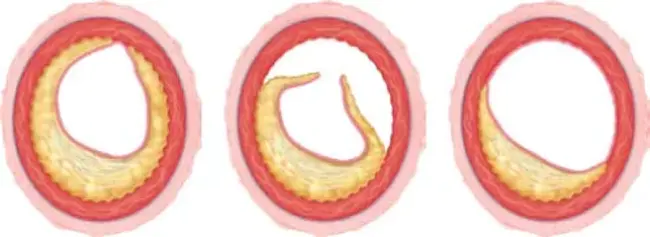 Subintimal angioplasty : 下血管成形术