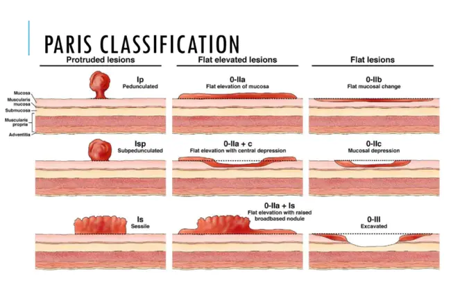 submucosal resection : 粘膜下切除术