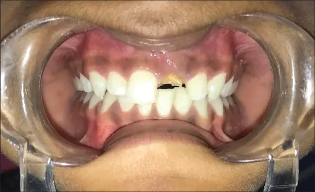 Supportive Periodontal Therapy : 支持性牙周治疗