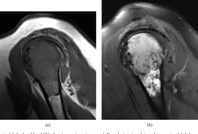 Synovial Sarcoma : 滑膜肉瘤