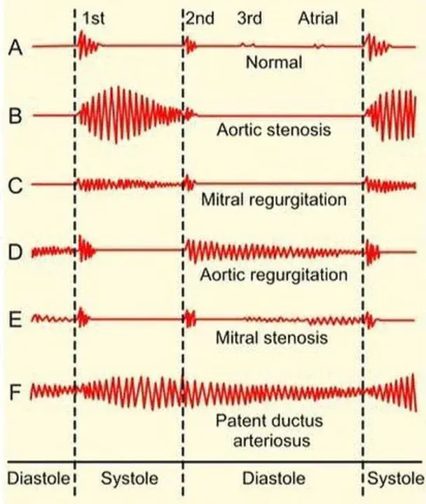 Systolic Peak Velocity : 收缩峰值速度