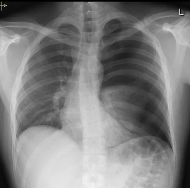 Tension Pneumothorax : 张力性气胸