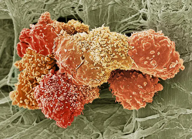 teratocarcinoma : 畸胎癌