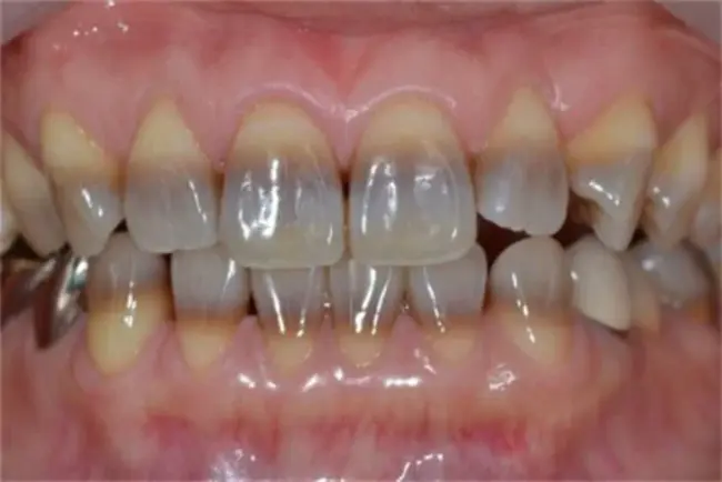 Tetracycline-Induced Steatosis : 四环素诱导脂肪变性