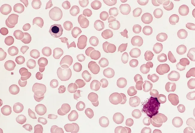 thrombocytopaenia : 血小板减少症