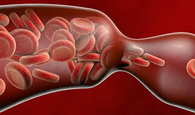 thromboembolic complications : 血栓栓塞并发症