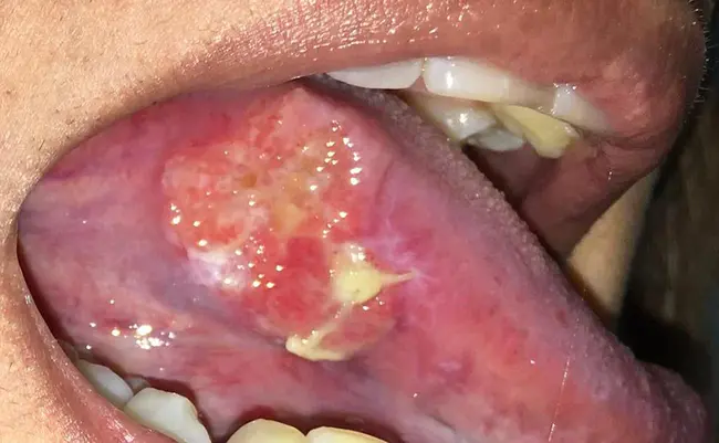 Tongue Carcinoma : 舌癌