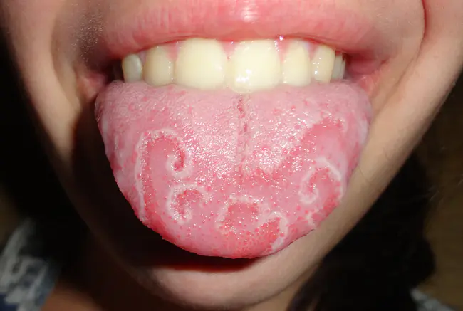 Tongue Protrusion : 舌突出