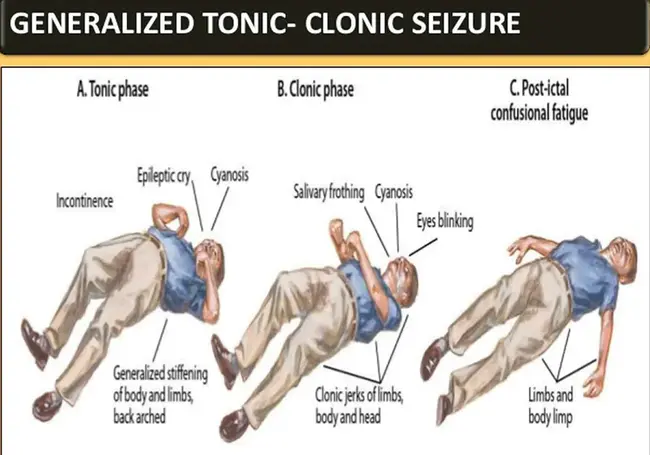 Tonic-Clonic Seizure : 强直阵挛性发作