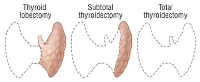 Total Pancreatectomy : 全胰腺切除术