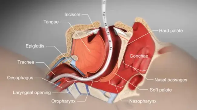 Tracheal Cartilaginous Sleeve : 气管软骨套