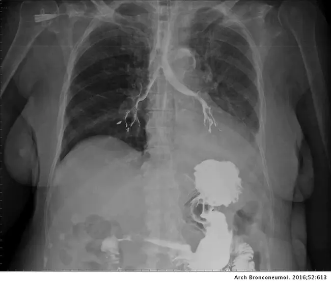 tracheobronchial amyloidosis : 气管支气管淀粉样变性