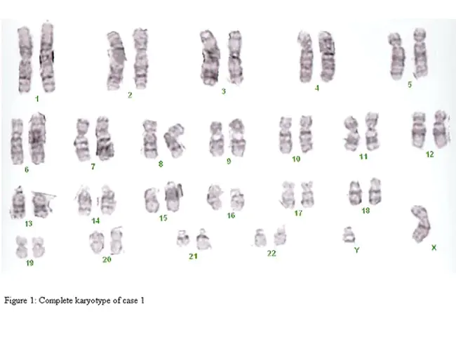 translocation E26 leukaemia : 易位E26白血病