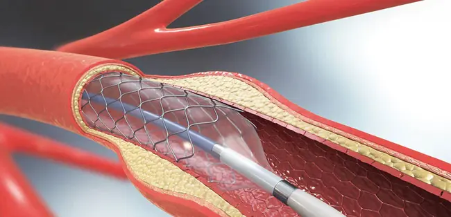 transluminal angioplasty : 腔内血管成形术