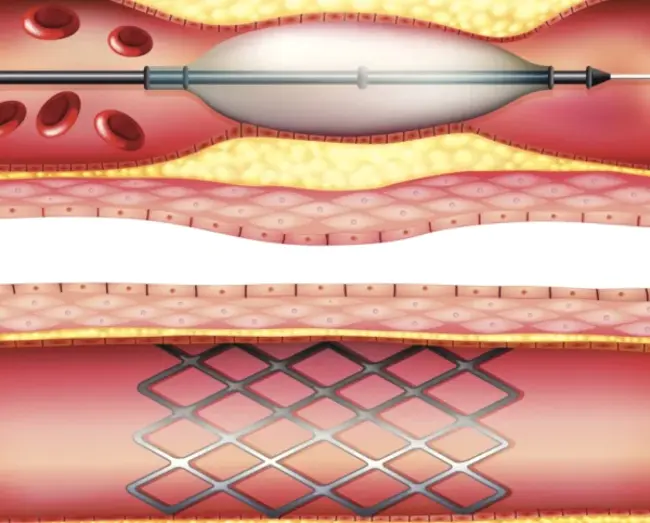 Transluminal Balloon Angioplasty : 腔内球囊血管成形术